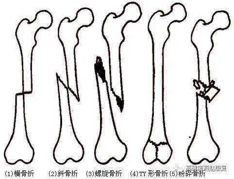 骨折后患者的康复